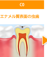 C0エナメル質表面の虫歯