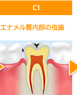 C1エナメル質内部の虫歯