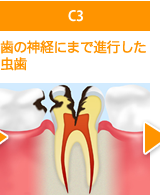 C3歯の神経にまで進行した虫歯