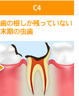 C4歯の根しか残っていない末期の虫歯